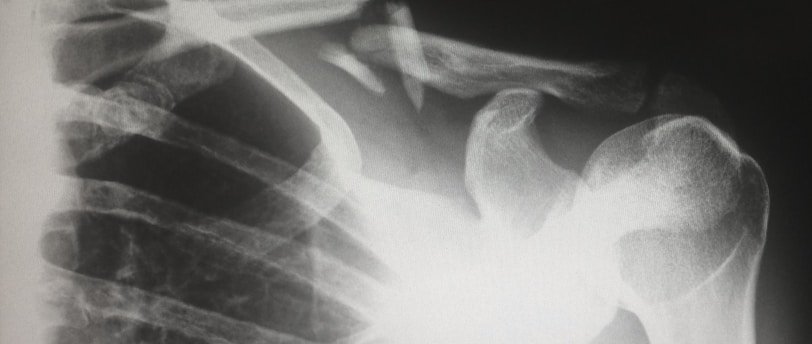 OBLIGATION D’INFORMER LE CSE EN CAS D’ACCIDENT DE TRAVAIL D’UN SALARIÉ